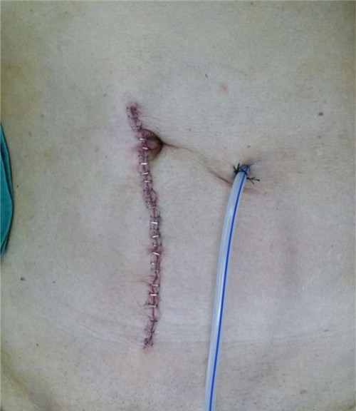 開腹乙狀結腸癌根治術(shù)切口.jpg